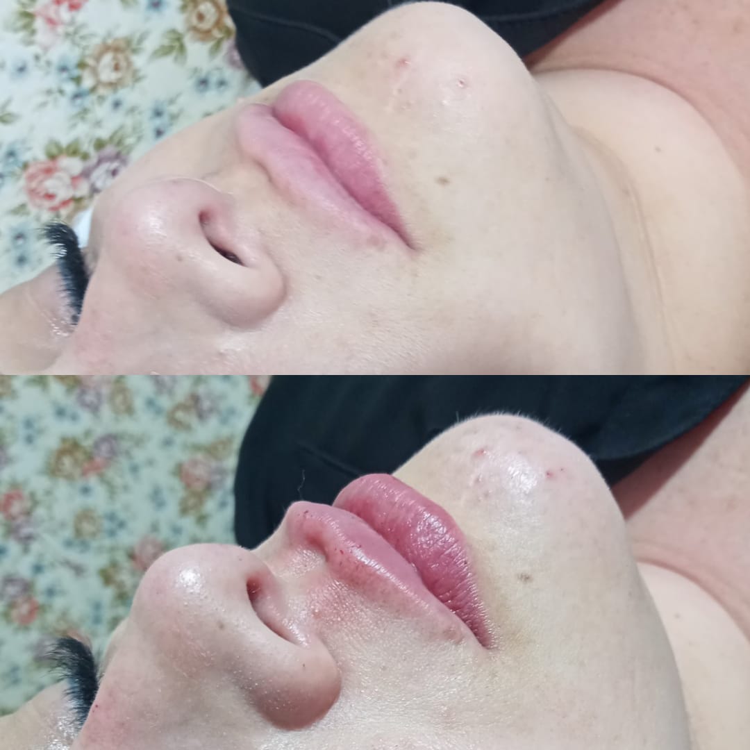 Antes e depois — Preenchimento labial