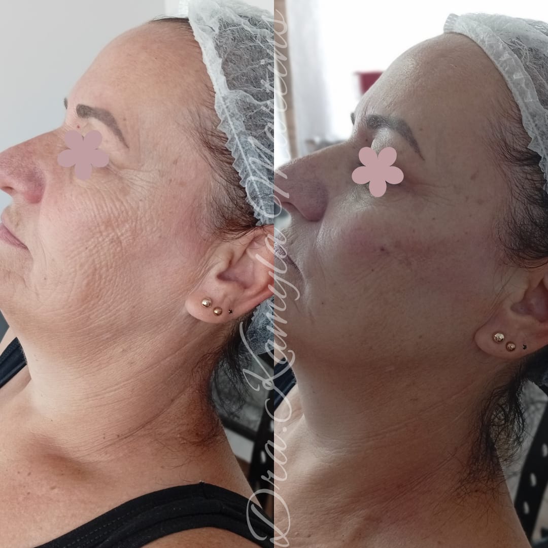 Antes e depois — Preenchimento de malar