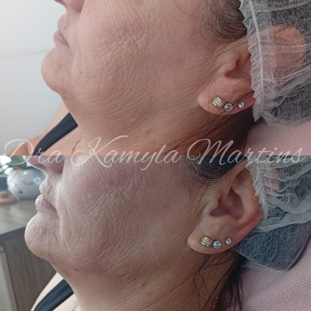 Preenchimento de mandíbula