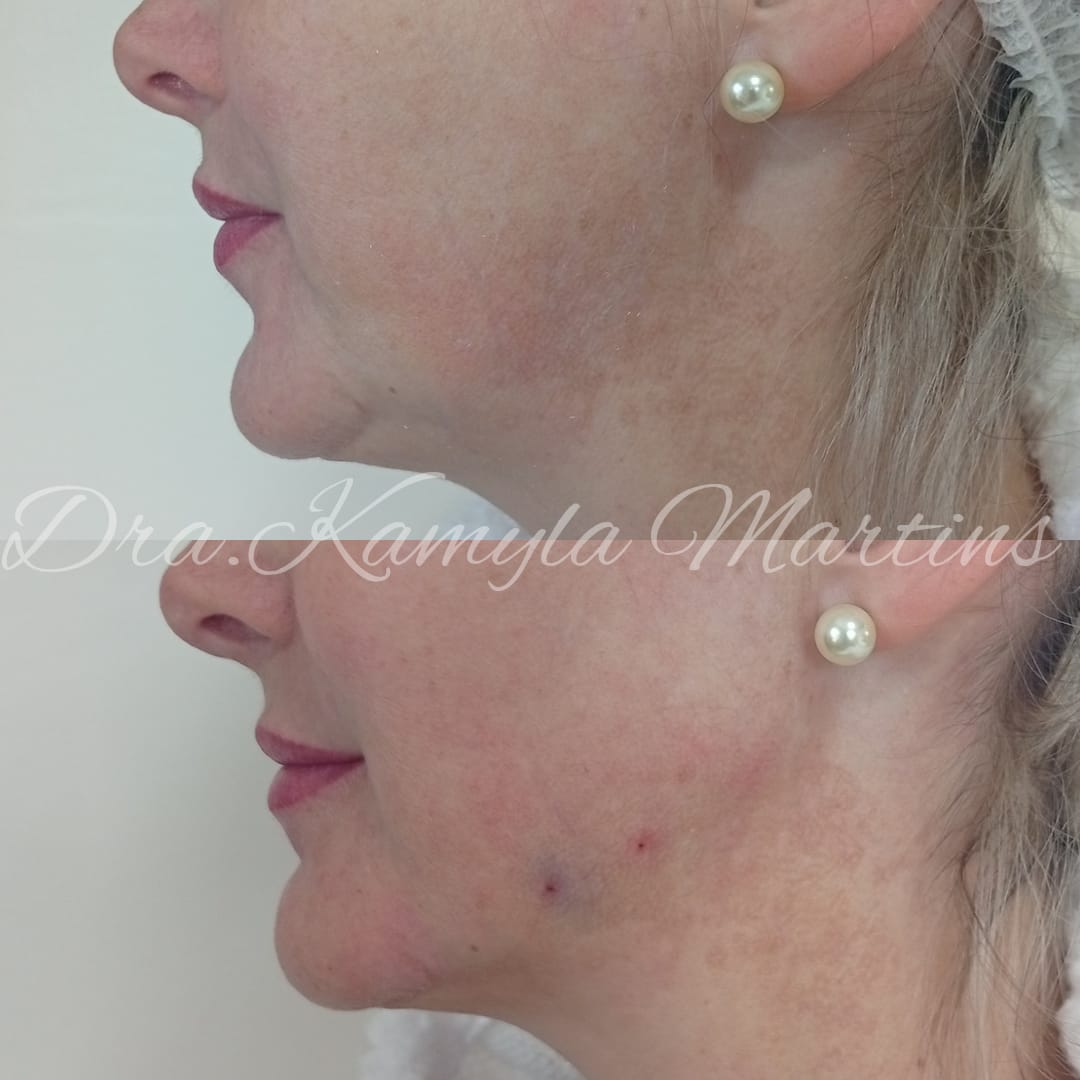 Antes e depois — Mandíbula e pré-jowl