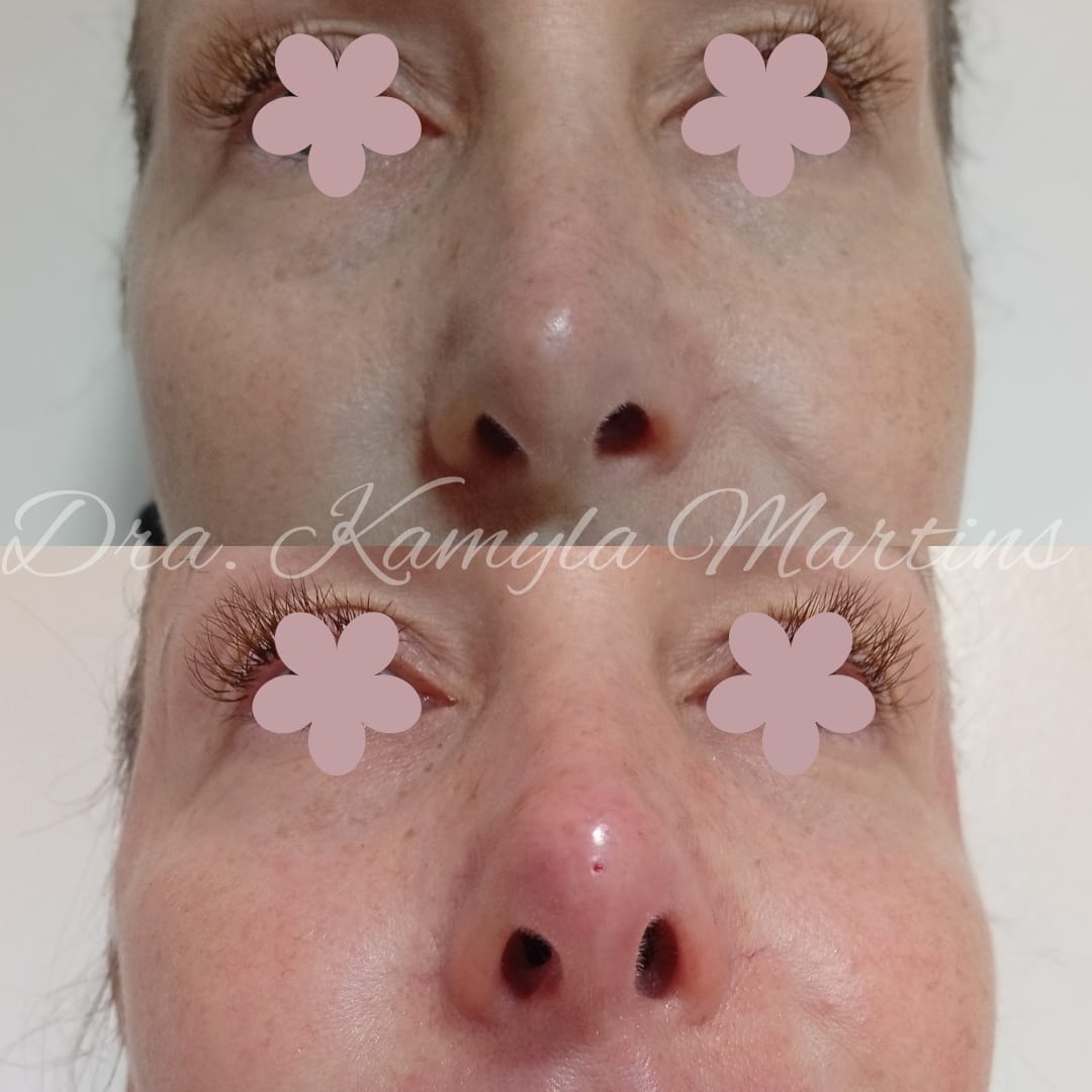 Antes e depois — Região nasal e têmporas