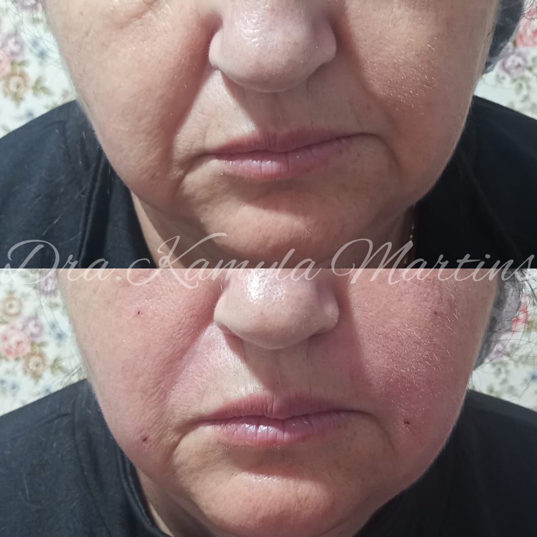 Antes e depois — Sulco nasogeniano