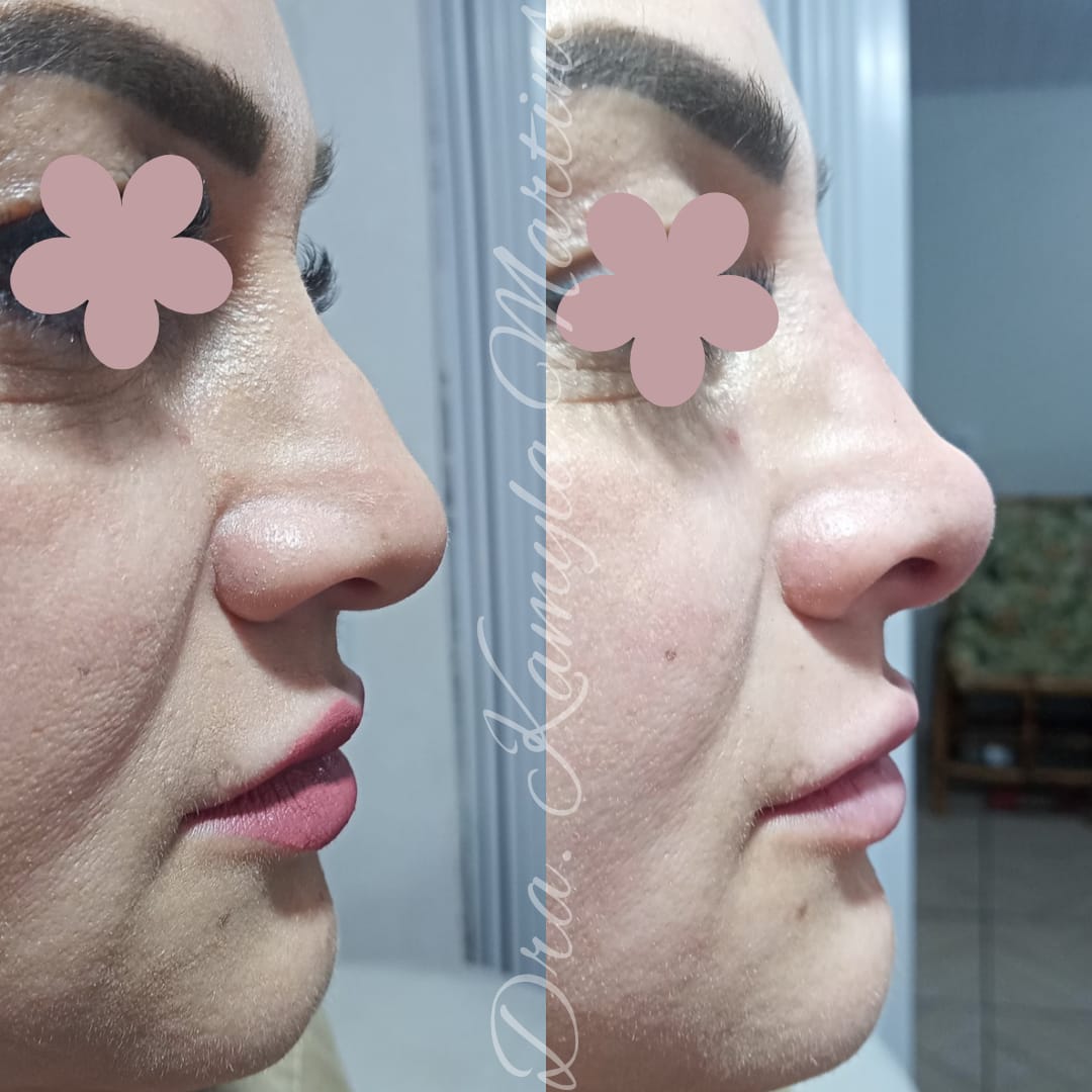 Antes e depois — Rinomodelação