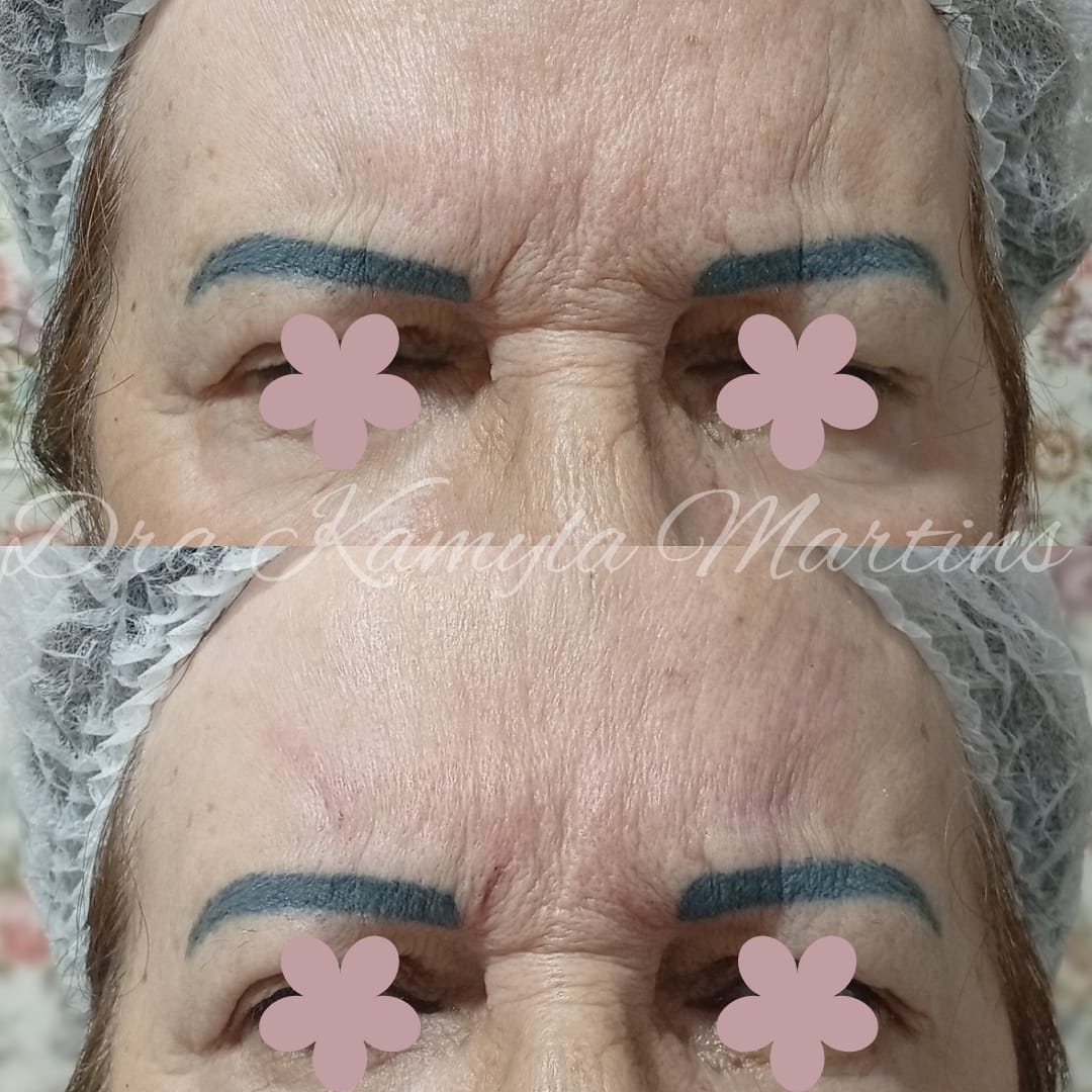 Antes e depois — Skinbooster em rugas frontais